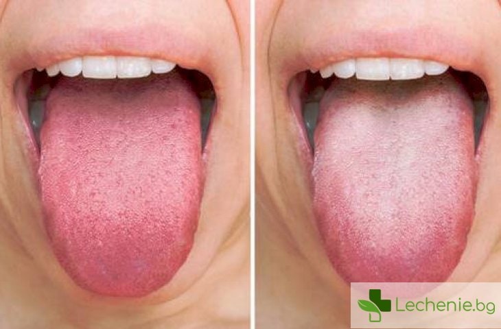 Симптоми и лечение на гъбичките по езика